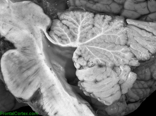 Sagittal gross section of normal midbrain